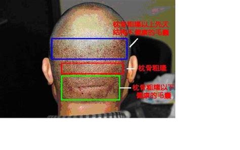 枕骨突出面相